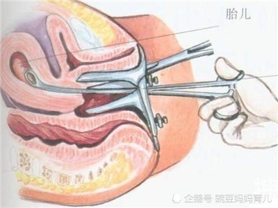 六个月引产是否需要清宫，深度解析与指导