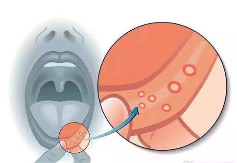 每个月都会遭遇口腔溃疡的挑战