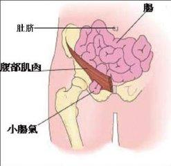 两个月大婴儿的疝气手术，理解、准备与关怀